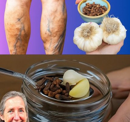 🌿 Natural Relief for Varicose Veins with Garlic and Cloves 🌿 Natural Relief for Varicose Veins with Garlic and Cloves