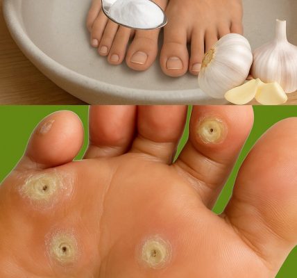 Uncover the Secret: Eliminate Plantar Warts with Garlic Magic 🌿 Uncover the Secret: Eliminate Plantar Warts with Garlic Magic 🌿