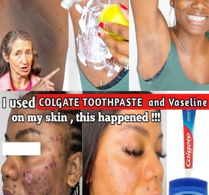 Toothpaste and Lemon for Skin: A Glow-Boosting Trick or a Risky Gamble? Toothpaste and Lemon for Skin: A Glow-Boosting Trick or a Risky Gamble?