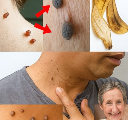 Banana Peels: The Surprising Natural Secret to Banish Skin Tags Banana Peels: The Surprising Natural Secret to Banish Skin Tags