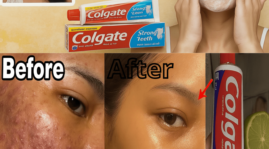 Can Colgate Toothpaste and Lemon Really Brighten Your Skin? The Shocking Truth Revealed Can Colgate Toothpaste and Lemon Really Brighten Your Skin? The Shocking Truth Revealed