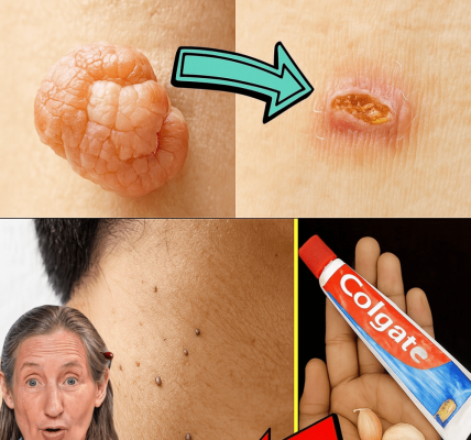 🌿 Banish Warts and Skin Tags Naturally: The 3-Ingredient Kitchen Remedy You’ll Wish You Tried Sooner 🌿 Banish Warts and Skin Tags Naturally: The 3-Ingredient Kitchen Remedy You’ll Wish You Tried Sooner