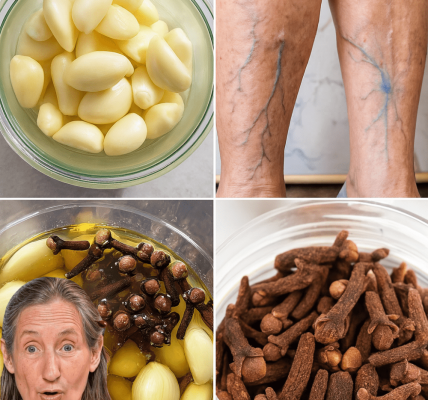 Garlic Clove and Clove Infusion: Banish Varicose Veins Naturally Garlic Clove and Clove Infusion: Banish Varicose Veins Naturally