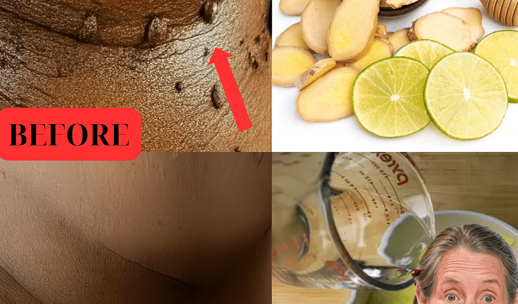 Say Goodbye to Skin Tags Forever: The Lemon and Ginger Secret You NEED to Know! Say Goodbye to Skin Tags Forever: The Lemon and Ginger Secret You NEED to Know!