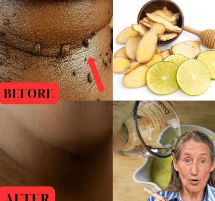 Say Goodbye to Skin Tags Forever: The Lemon and Ginger Secret You NEED to Know! Say Goodbye to Skin Tags Forever: The Lemon and Ginger Secret You NEED to Know!
