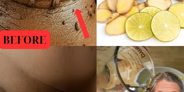 Say Goodbye to Skin Tags Forever: The Lemon and Ginger Secret You NEED to Know!