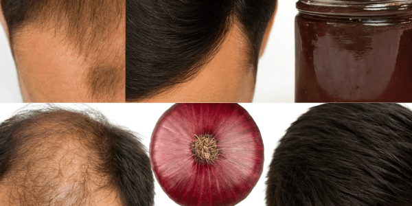 Red Onion for Hair Growth: Unlock the Secret to Thicker, Stronger Hair Red Onion for Hair Growth: Unlock the Secret to Thicker, Stronger Hair