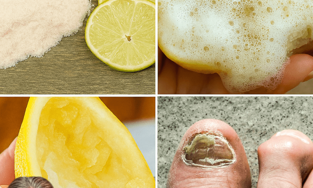 đ Discover the Secret to Banishing Nail Fungus Naturally with Lemon and Salt đ Discover the Secret to Banishing Nail Fungus Naturally with Lemon and Salt