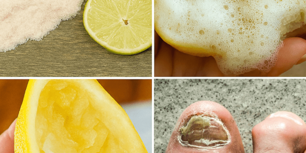 🌟 Discover the Secret to Banishing Nail Fungus Naturally with Lemon and Salt