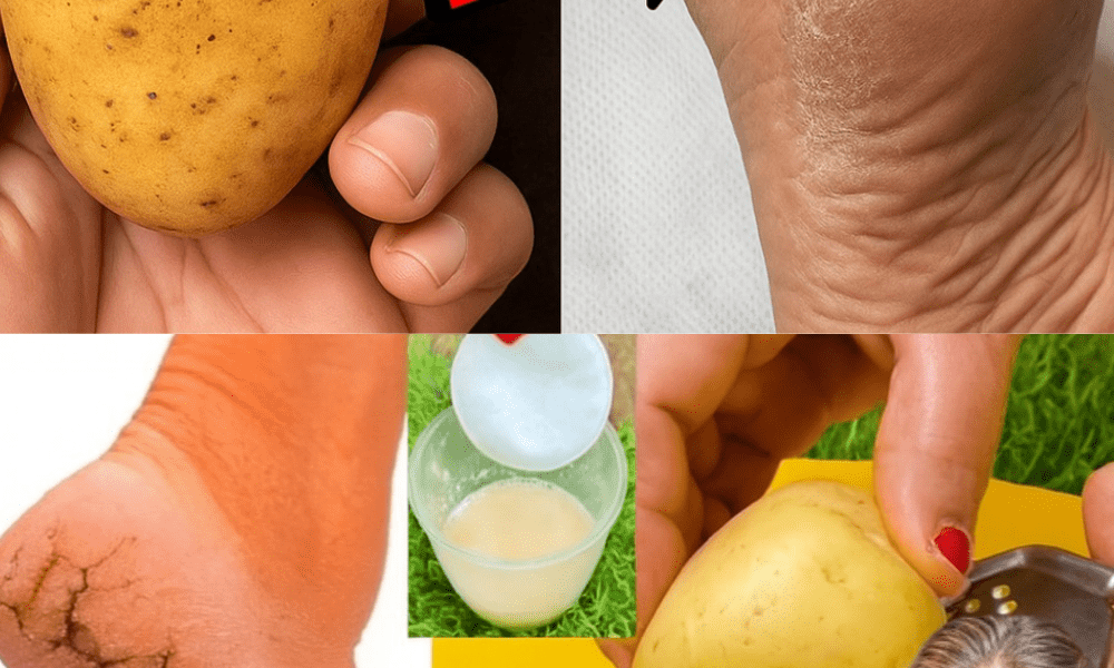 đ„ Transform Your Cracked Heels with Potatoes: The Surprising Secret Youâll Wish You Tried Sooner đ„ Transform Your Cracked Heels with Potatoes: The Surprising Secret Youâll Wish You Tried Sooner