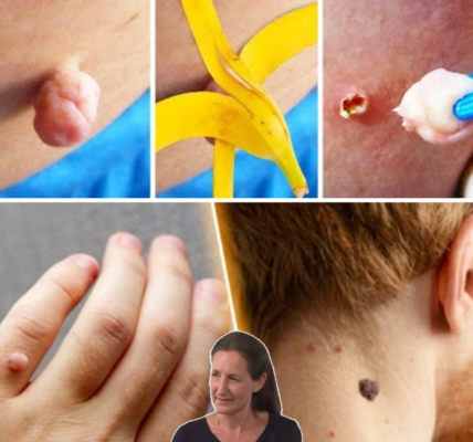 How to Remove Skin Tags on Your Face Naturally with Banana Peel and Other Safe Remedies How to Remove Skin Tags on Your Face Naturally with Banana Peel and Other Safe Remedies