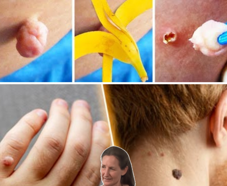 How to Remove Skin Tags on Your Face Naturally with Banana Peel and Other Safe Remedies How to Remove Skin Tags on Your Face Naturally with Banana Peel and Other Safe Remedies