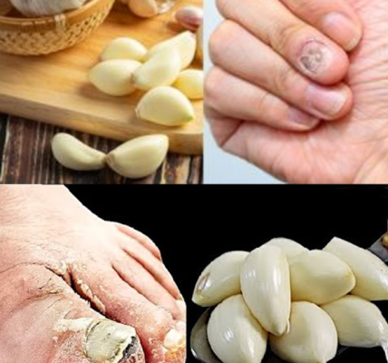 The Fastest Natural Remedy for Nail Fungus Is in Your Kitchen—And It’s Garlic The Fastest Natural Remedy for Nail Fungus Is in Your Kitchen—And It’s Garlic