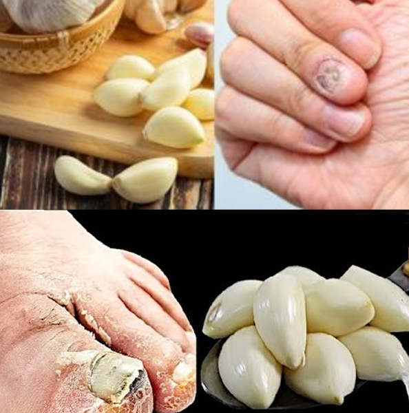 The Fastest Natural Remedy for Nail Fungus Is in Your Kitchen—And It’s Garlic The Fastest Natural Remedy for Nail Fungus Is in Your Kitchen—And It’s Garlic