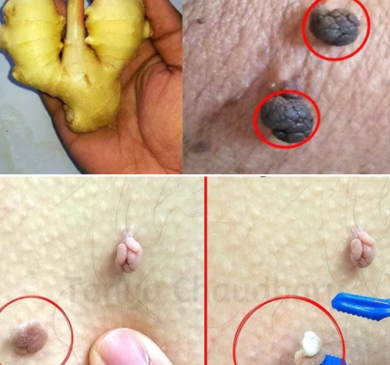 How I Gently Removed Skin Tags at Home Using Lemon & Ginger How I Gently Removed Skin Tags at Home Using Lemon & Ginger