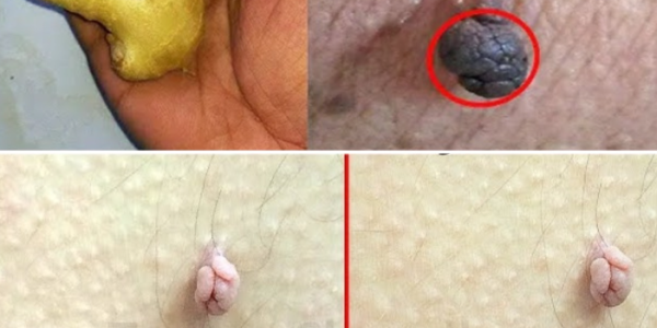 How I Gently Removed Skin Tags at Home Using Lemon & Ginger