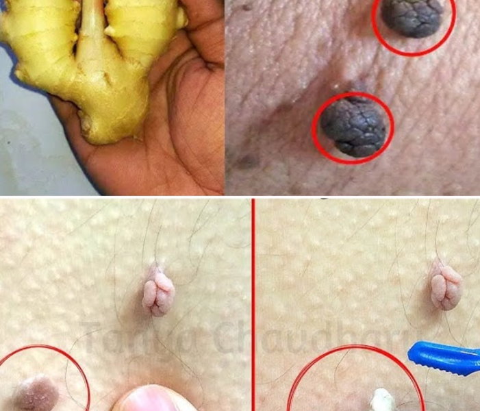 How I Gently Removed Skin Tags at Home Using Lemon & Ginger How I Gently Removed Skin Tags at Home Using Lemon & Ginger
