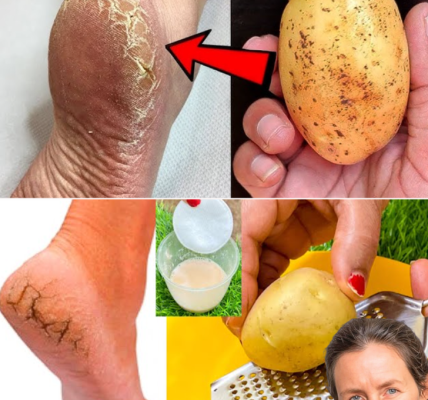 Transform Your Cracked Heels with a Potato: The Surprising Natural Remedy Youâll Wish You Knew Sooner Transform Your Cracked Heels with a Potato: The Surprising Natural Remedy Youâll Wish You Knew Sooner