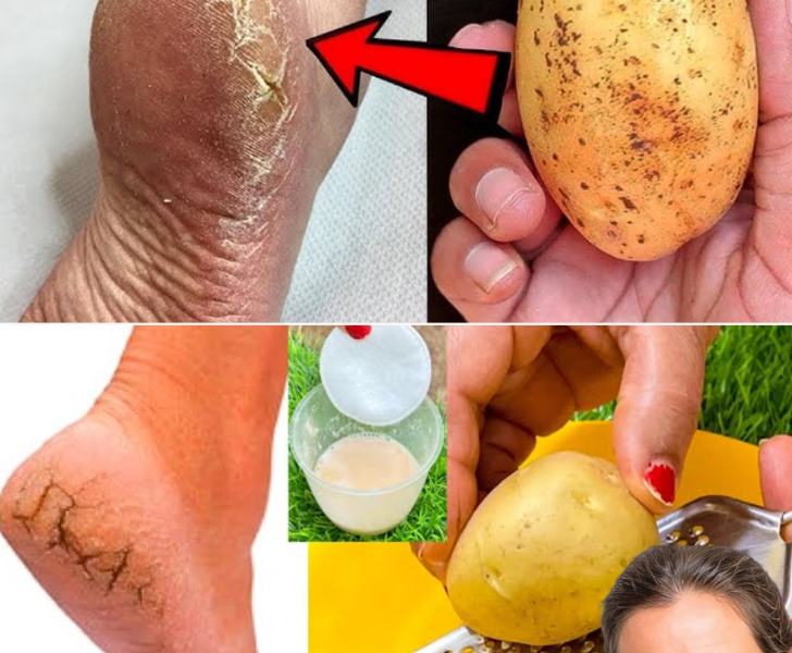 Transform Your Cracked Heels with a Potato: The Surprising Natural Remedy You’ll Wish You Knew Sooner Transform Your Cracked Heels with a Potato: The Surprising Natural Remedy You’ll Wish You Knew Sooner