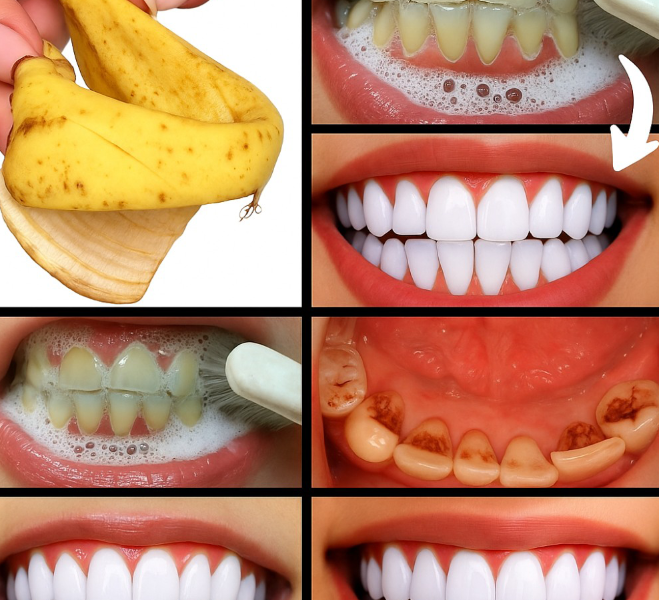 Do Bananas Really Help Whiten Teeth? Here’s What You Need to Know Do Bananas Really Help Whiten Teeth? Here’s What You Need to Know
