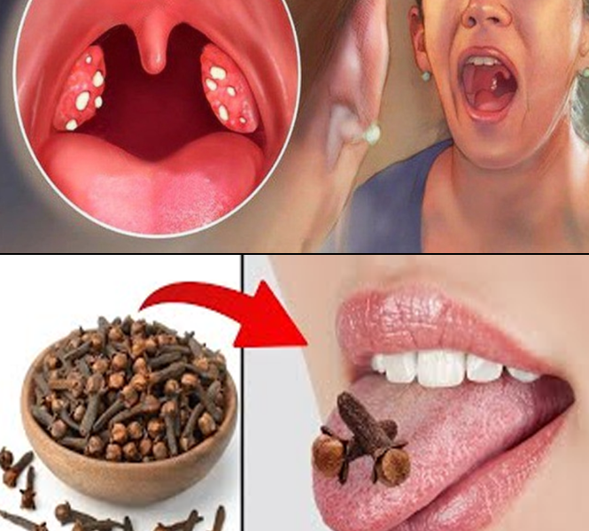 Cloves for Sore Throat Relief: A Natural Way to Soothe Inflammation and Support Healing Cloves for Sore Throat Relief: A Natural Way to Soothe Inflammation and Support Healing
