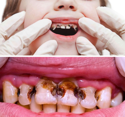 Can This Secret Remedy Reverse Tooth Decay and Restore Your Smile? Can This Secret Remedy Reverse Tooth Decay and Restore Your Smile?