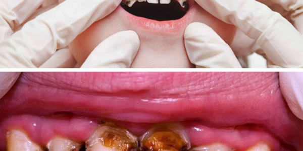 Can This Secret Remedy Reverse Tooth Decay and Restore Your Smile?