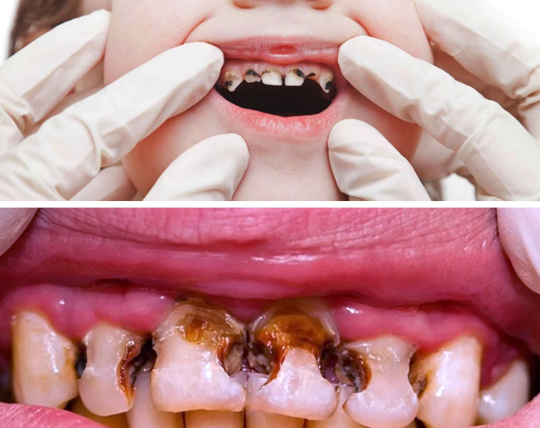 Can This Secret Remedy Reverse Tooth Decay and Restore Your Smile? Can This Secret Remedy Reverse Tooth Decay and Restore Your Smile?