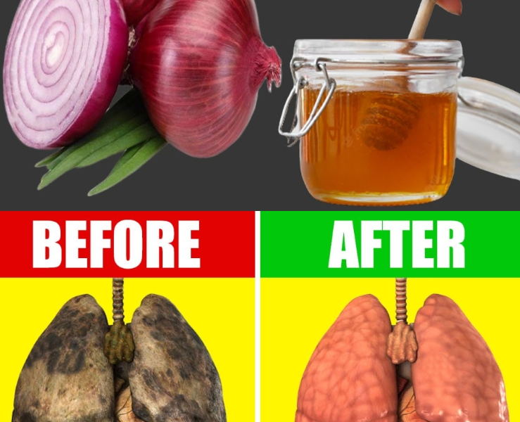 Breathe Easy Again: A Natural Way to Soothe Your Lungs with Onion and Honey Breathe Easy Again: A Natural Way to Soothe Your Lungs with Onion and Honey
