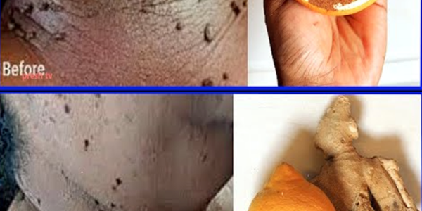 Lemon and Ginger: Simple Ways to Support Your Wellness and Skin Health