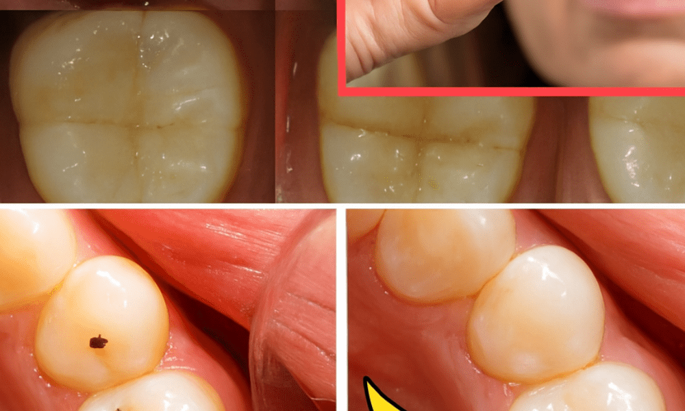 🦷 How to Naturally Repair a Cavity: Powerful Tips to Strengthen Your Teeth and Avoid the Dentist 🦷 How to Naturally Repair a Cavity: Powerful Tips to Strengthen Your Teeth and Avoid the Dentist