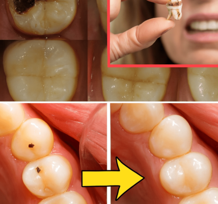 🦷 How to Naturally Repair a Cavity: Powerful Tips to Strengthen Your Teeth and Avoid the Dentist 🦷 How to Naturally Repair a Cavity: Powerful Tips to Strengthen Your Teeth and Avoid the Dentist
