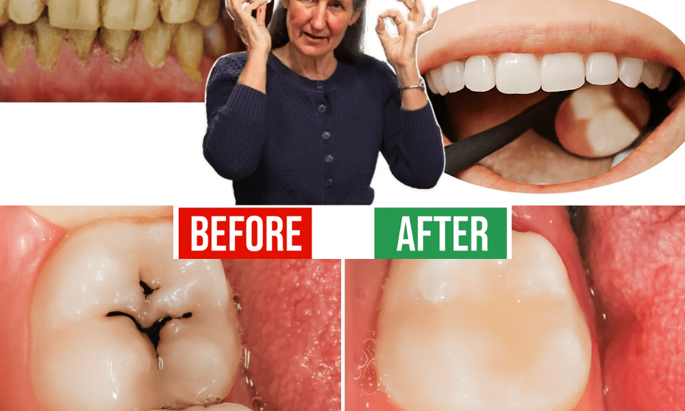 Stop Cavities in Their Tracks: Natural Secrets for a Stronger, Healthier Smile 🦷✨ Stop Cavities in Their Tracks: Natural Secrets for a Stronger, Healthier Smile 🦷✨
