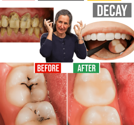 Stop Cavities in Their Tracks: Natural Secrets for a Stronger, Healthier Smile 🦷✨ Stop Cavities in Their Tracks: Natural Secrets for a Stronger, Healthier Smile 🦷✨