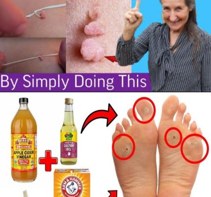 Plantar Warts and Skin Tags Disappear Naturally—Try This Overnight Remedy Plantar Warts and Skin Tags Disappear Naturally—Try This Overnight Remedy