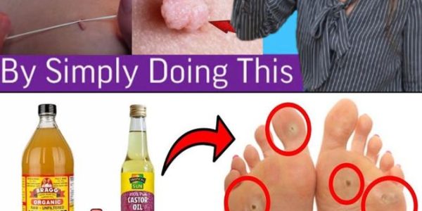 Plantar Warts and Skin Tags Disappear Naturally—Try This Overnight Remedy