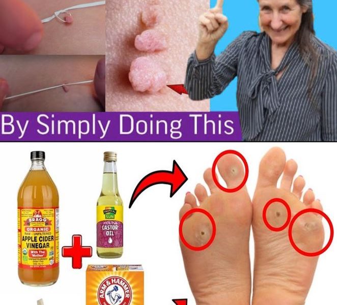 Plantar Warts and Skin Tags Disappear Naturally—Try This Overnight Remedy Plantar Warts and Skin Tags Disappear Naturally—Try This Overnight Remedy