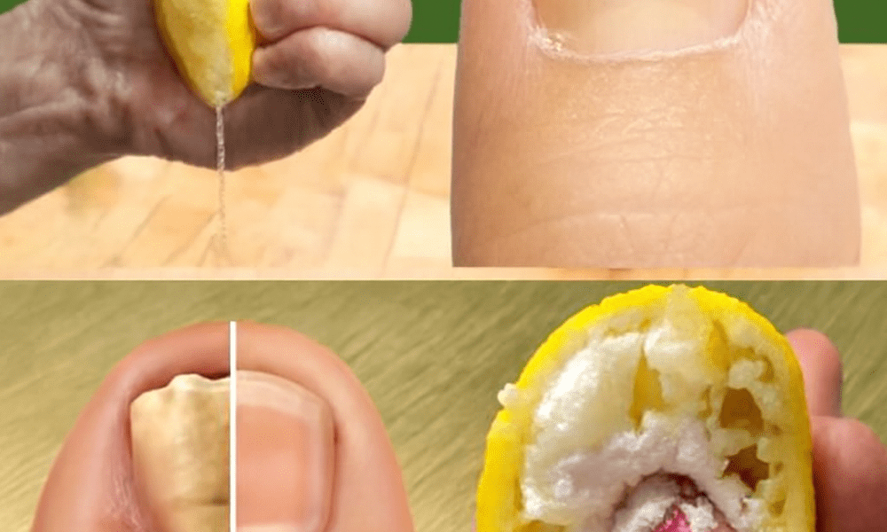 šæ Banish Toenail Fungus Forever: The Astonishing Power of Lemon and Garlic šæ Banish Toenail Fungus Forever: The Astonishing Power of Lemon and Garlic