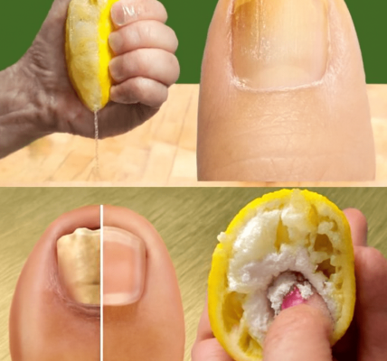 šæ Banish Toenail Fungus Forever: The Astonishing Power of Lemon and Garlic šæ Banish Toenail Fungus Forever: The Astonishing Power of Lemon and Garlic