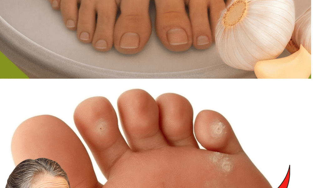 🧄 Banish Plantar Warts Naturally: The Surprising Power of Garlic Remedies 🧄 Banish Plantar Warts Naturally: The Surprising Power of Garlic Remedies