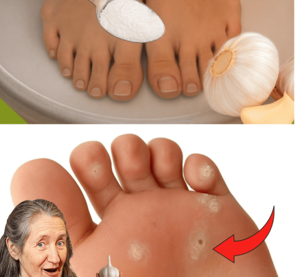🧄 Banish Plantar Warts Naturally: The Surprising Power of Garlic Remedies 🧄 Banish Plantar Warts Naturally: The Surprising Power of Garlic Remedies