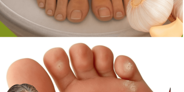 đź§„ Banish Plantar Warts Naturally: The Surprising Power of Garlic Remedies đź§„ Banish Plantar Warts Naturally: The Surprising Power of Garlic Remedies