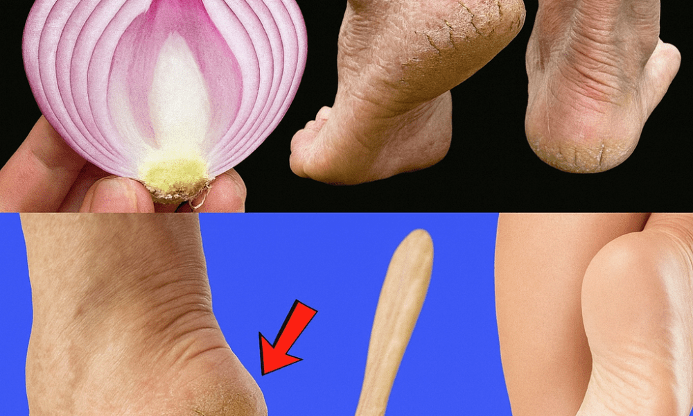 🌿 Say Goodbye to Cracked Heels: 5 Natural Remedies That Truly Work 🌿 Say Goodbye to Cracked Heels: 5 Natural Remedies That Truly Work