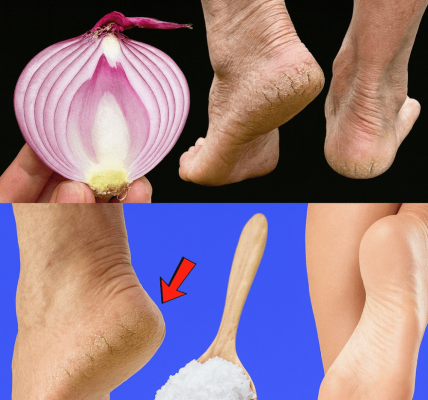 šæ Say Goodbye to Cracked Heels: 5 Natural Remedies That Truly Work šæ Say Goodbye to Cracked Heels: 5 Natural Remedies That Truly Work