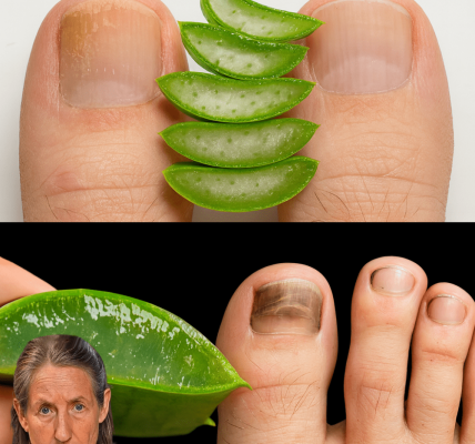 🔥 Banish Nail Fungus Fast: The Ultimate Aloe Vera Remedy for Clear, Healthy Nails 🔥 Banish Nail Fungus Fast: The Ultimate Aloe Vera Remedy for Clear, Healthy Nails