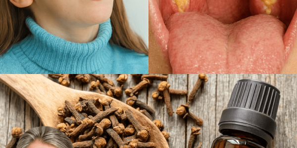 🌟 Cloves: Nature’s Tiny Powerhouse to Crush Sore Throats and Inflammation 🌟 Cloves: Nature’s Tiny Powerhouse to Crush Sore Throats and Inflammation