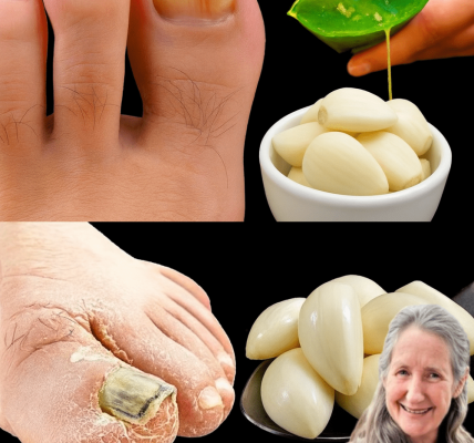 🌿 Banish Toenail Fungus Naturally: 5 Powerful Home Remedies Backed by Nature 🌿 Banish Toenail Fungus Naturally: 5 Powerful Home Remedies Backed by Nature