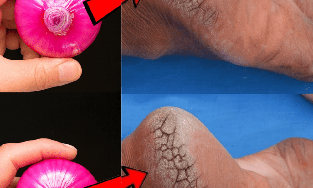 š£ Onion Magic: Transform Cracked Heels into Silky-Smooth Feet in Just 7 Days š£ Onion Magic: Transform Cracked Heels into Silky-Smooth Feet in Just 7 Days