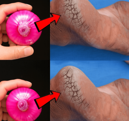 👣 Onion Magic: Transform Cracked Heels into Silky-Smooth Feet in Just 7 Days 👣 Onion Magic: Transform Cracked Heels into Silky-Smooth Feet in Just 7 Days