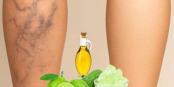 A Natural Cure for Varicose Veins That Transforms Your Legs A Natural Cure for Varicose Veins That Transforms Your Legs